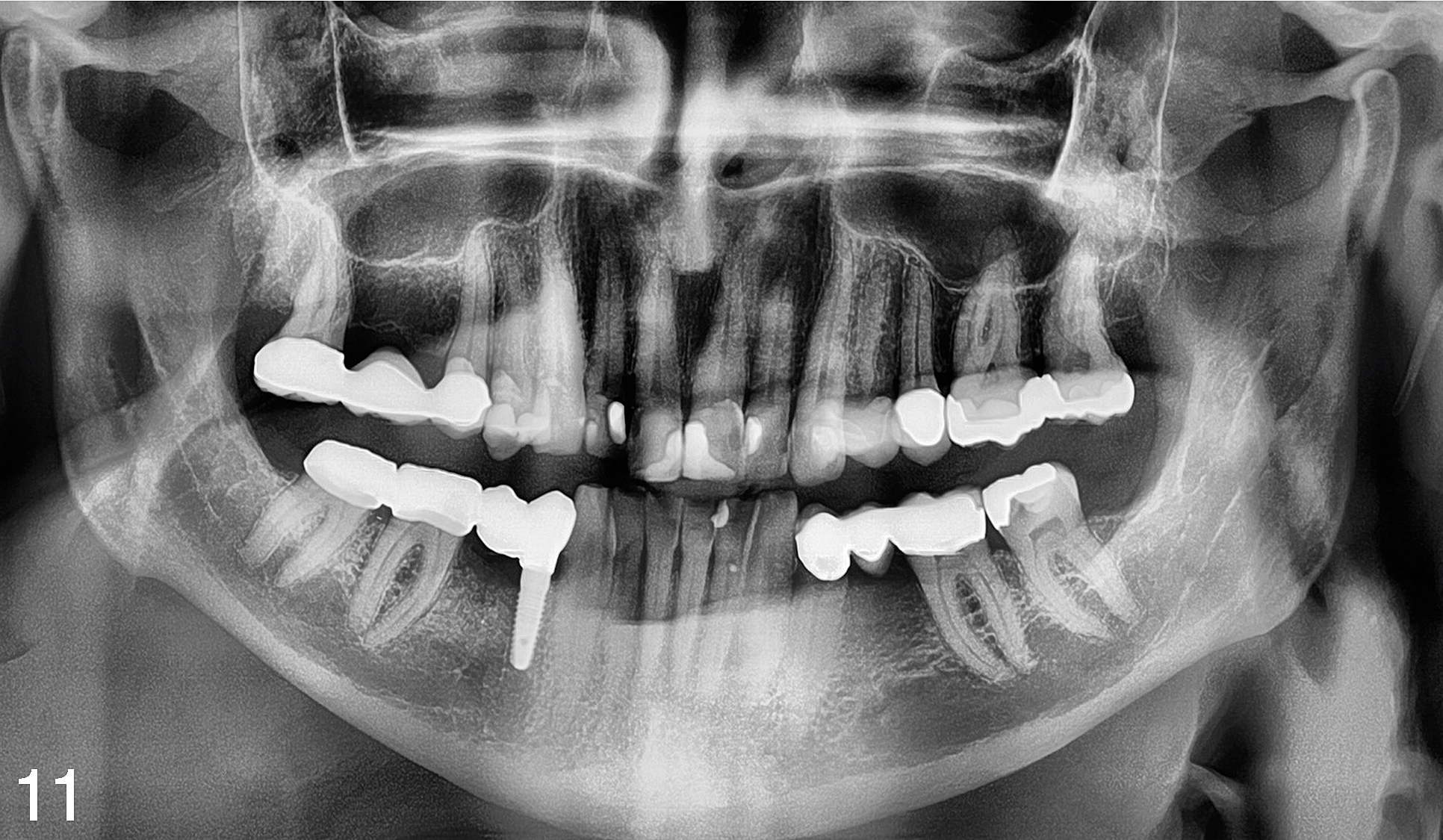 Hybrid bridge (posterior teeth #30 and #31 and implant #28) performed by general dentist after 9 months. Vertical dimension of the bone remains stable.