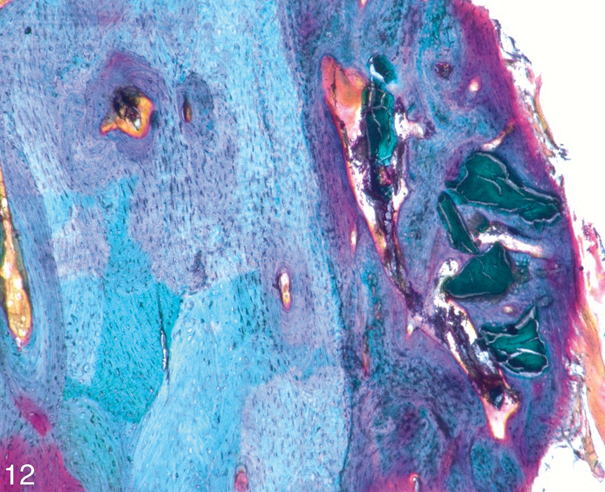 Magnification reveals newly formed bone (darker purple right part) tightly adherent to the residual bone plate (lighter blue staining left). Bio-Oss particles appear in green colors embedded in newly formed bone (right) (toluidine and Masson Goldner, amplification: 400-fold, digital microscope: Keyence VHX-2000D).