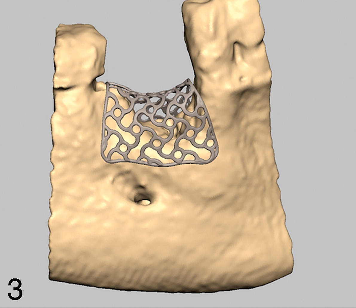 Extraction of the three-dimensional surface data from DICOM files reveals the definition of augmentation volume according to prosthetic backward planning. The inner contour of the lattice structure represents the desired augmentation volume.