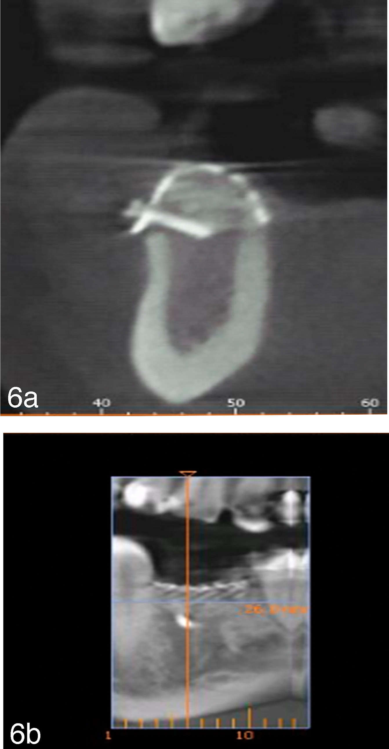 Sections of the cone beam tomography 6 months after insertion showing a radiologic sufficient amount of augmented bone.