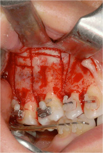 Figure 10. A triangular-shaped corticotomy was performed with inserts OT7 0.55 mm and OT7 special 0.35 mm to accelerate orthodontic tooth movements