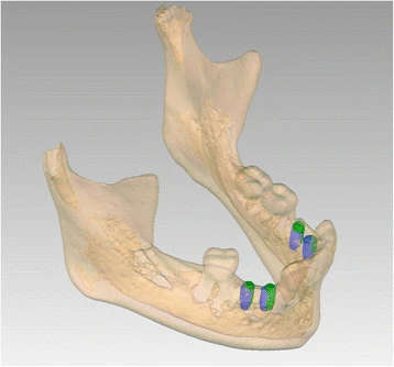 Figure 10. Patient 1—post-operative evaluation of placement accuracy of the implants in the mandible. Green is the planned position; blue is the actual position