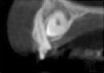 Figure 11. CBCT image showing the palatal location of the impacted secondary canine