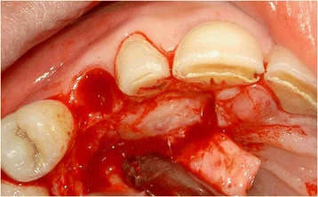 Figure 12. The impacted canine has become visible after elevation of a full-thickness palatal flap and removing overlying bone
