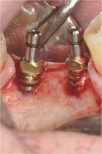 Figure 14. Implants placement after site preparation