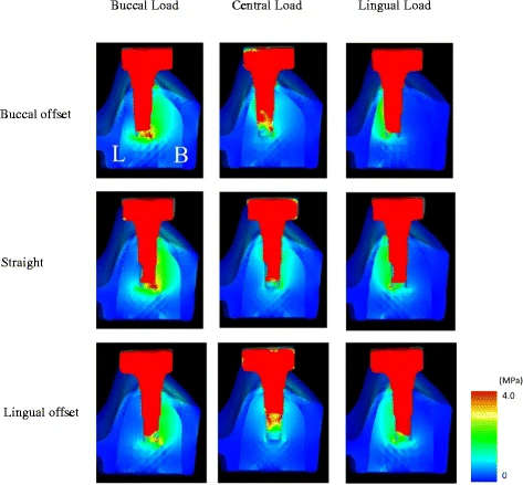 Figure 14. The distribution of equivalent stress around the no. 36 implant in the finite element analysis (FEA) models
