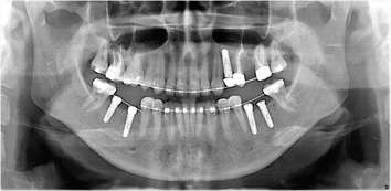 Figure 15. All implants received immediate healing screws
