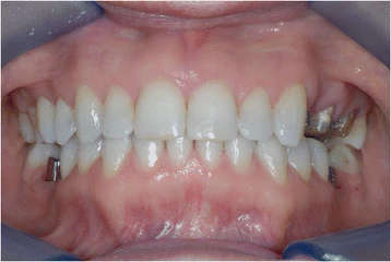 Figure 16. After orthodontic treatment was completed, the prosthodontic phase took place