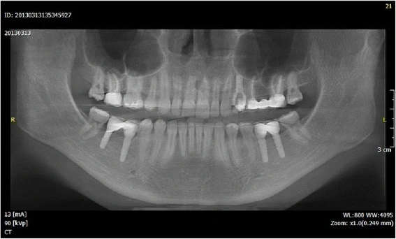 Figure 18. OPT after prosthodontic finalization