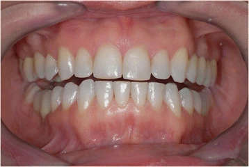 Figure 19. A full-mouth frontal aspect