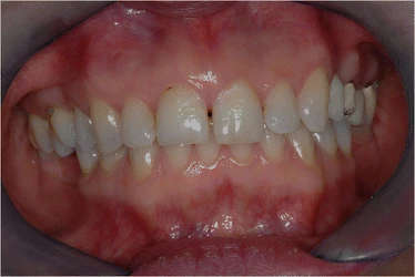 Figure 1. Initial frontal intraoral aspect