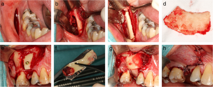 Figure 1. Intraoperative photos illustrating bone harvesting and lateral bone augmentation in the PRF group. Initially, an incision is made at the lateral aspect of the posterior part of the mandibular corpus (a) followed by exposing the mucoperiosteal flap (b), before making the osteotomy line (c). The bone block (d) is then retrieved before adjusted to the contour at the recipient site and fixated with an osteosynthesis screw (e). Autogenous bone graft particles are packed around the graft before covering the grafted area with three PRF membranes (f and g). Finally, tension-free primary wound closure is performed before suturing (h)