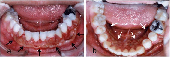 Figure 1. Intraoral photograph showing diffuse tumor formation on the alveolar gingiva (arrows)