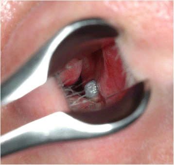 Figure 1. On anterior rhinoscopy, the apical part of the titanium dental implant in the right anterior maxilla was seen in the nasal floor close to the nasal septum