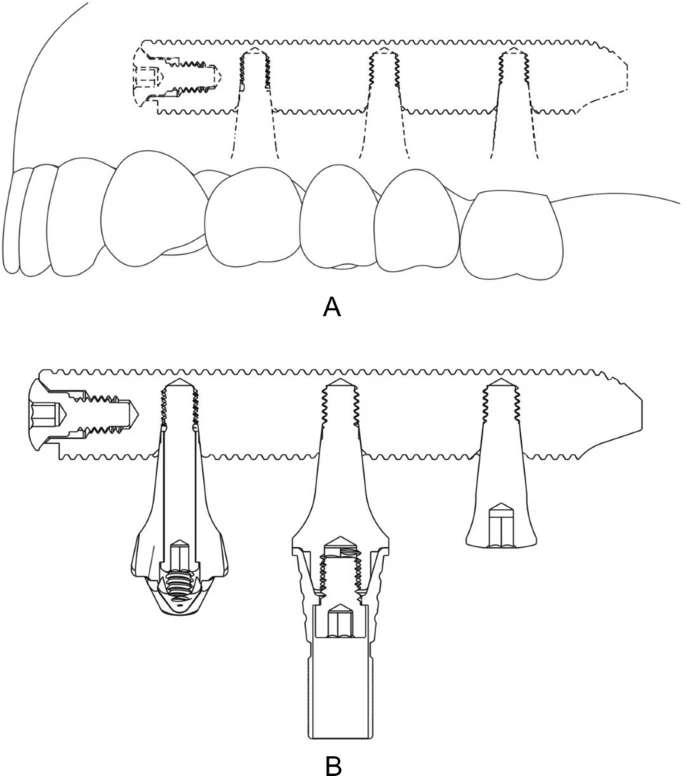 Figure 1. Schematic drawing of the transmaxillary implant. Perforation is made using the 2.0 mm lance implant, for giving guidance and stability to the next drill, using the 3.0 mm implant