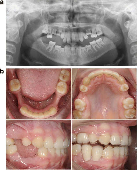 Figure 1. a Patient 1—orthopantomogram (OPT) at age of 13. Situation before extraction of the ankylosed deciduous teeth 55, 54, 65, 74, 75, 84, and 85 and start of orthodontic treatment. Eleven permanent teeth (including 4 third molars) were congenitally missing. b Patient 1—post-orthodontic situation at age of 16. The top of the mandibular processus alveolaris is small (upper). The interdental space at location of the second premolars in the maxilla is 7 and 14 mm at location of the premolars in the mandible. Six dental implants were planned (locations 15, 25, 34, 35, 44 and 45). Implant placement (inclusive bone augmentation with the autogenous retromolar mandibular bone 3 months before implant placement at the place of the 25) was postponed until the age of 18. Essix retainers were used to safeguard the width of the diastemas