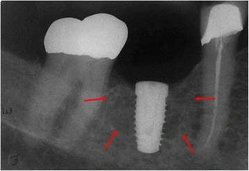 Figure 1. The periapical radiograph revealed the presence of an extensive and poorly circumscribed osteoporotic area around the proximal implant
