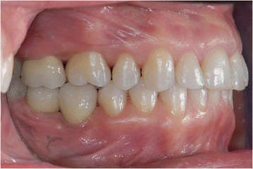 Figure 21. A dental class I occlusion was established only on the right side (lateral aspect)
