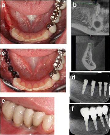 Figure 2. Case 1: Example of one case involved in the study. a Preoperative view of a partial edentulism in posterior mandible. b Preoperative CT scan. The width of the ridge was 4 mm. c Four narrow diameter implants were placed and left to a nonsubmerged healing. d Baseline periapical radiograph. e Buccal vieew of the final metal ceramic restoration. f Periapical radiograph at 1 year after loading