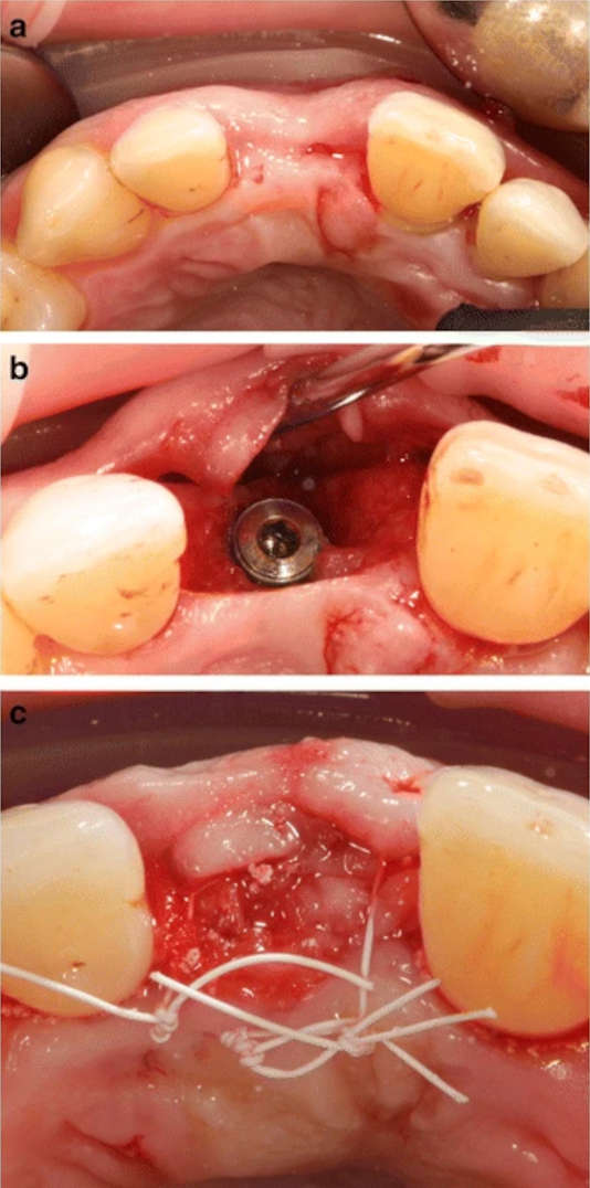 Figure 2. Clinical image of patient 4: a region 21 before implant placement. b, c Implant placement using the GBR procedure with a synthetic bone substitute material composed of HA + β-TCP