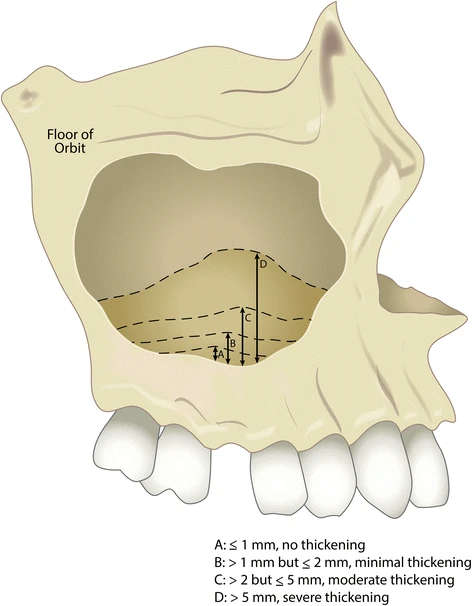 Figure 2. Figure illustrating the proposed mucosal thickening index. A ≤1 mm, indicating no thickening; B >1 mm but ≤2 mm, indicating minimal thickening; C >2 mm but ≤5 mm, indicating moderate thickening; D >5 mm, indicating severe thickening