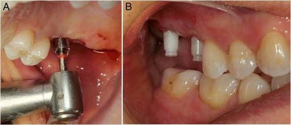 Figure 2. Flapless surgical technique, atraumatic surgical procedure for zirconium implants using the circular scalpel (a)–sharp, clean cut without bleeding (b)