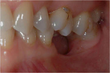 Figure 2. Initial lateral intraoral aspect