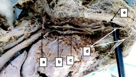 Figure 2. Lingual artery as the origin of the sublingual artery entering the MMLF: a external carotid artery, b lingual artery, c hypoglossal nerve, d right and left sublingual arteries originating from the ipsilateral lingual arteries and e inferior border of the mandible