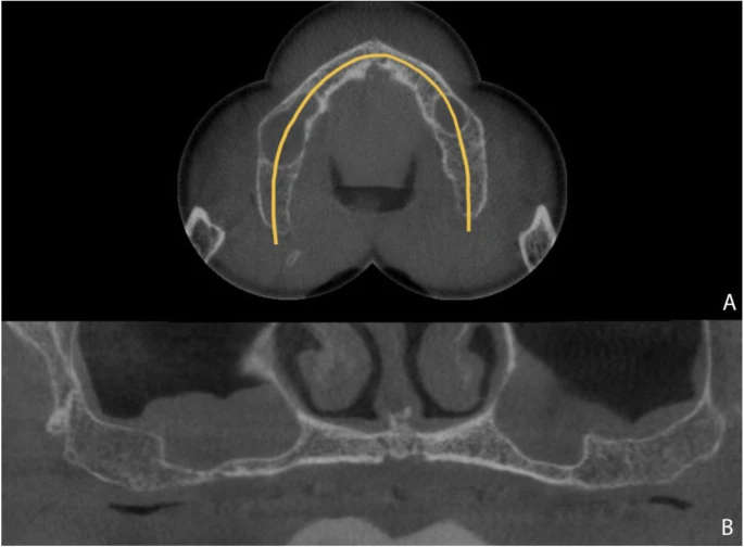 Figure 2. Maxillary computed tomography. a Axial view. b Coronal view