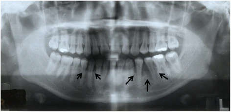 Figure 2. Panoramic radiograph showing notable alveolar bone resorption in the left mandibular premolar region and slight resorption in the right mandibular canine region (arrows)