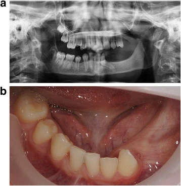 Figure 2 a Patient 2—pre-implant orthopantomogram (OPG) at the age of 12. Situation before start of orthodontic and implant treatment. Eleven permanent teeth (including 2 third molars) were congenitally missing and the 34 is impacted. To erect the 34, orthodontic treatment was desired. Due to the lack of stable anchorages in the third quadrant, it was decided to place one implant at tooth region 35 for orthodontic anchorage and future prosthetics. Due to very limited bone height virtual implant planning was needed to avoid damage to the mandibular nerve. b Patient 2—mandible, pre implant intra-oral situation at the age of 12. The 34 is not visible in the oral cavity