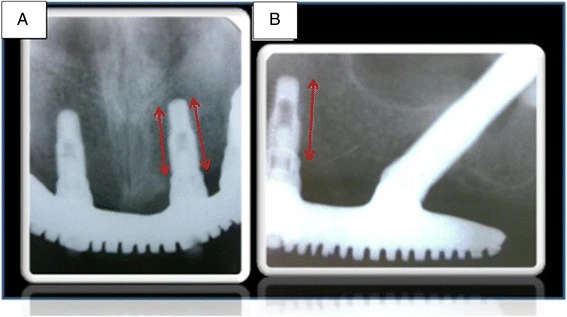 Figure 2. Periapical radiographs using the parallelism technique. a Conventional implants—anterior. b Conventional implants—posterior