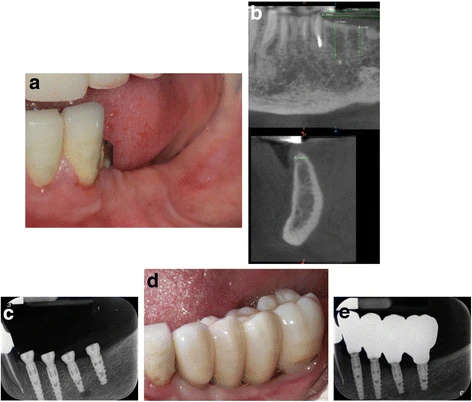 Figure 3. Example of another case involved in the study. a Preoperative view –premolars and molars are missing in left mandible. b Preoperative CT scan. The width of the ridge was around 4 mm. c Baseline periapical radiograph. Four narrow diameter implants were placed to restore the area. d Buccal view of the final full-contour zirconia restoration. e Periapical radiograph at 1 year after loading