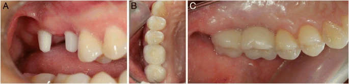 Figure 3. Final restaurations: The parallelism of the implants is achieved by carving the non-submerged part a occlusal view and b lingual view