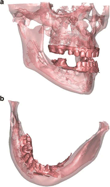 Figure 3. a Patient 1—detailed 3D model of the combined data from the CBCT and intra-oral scan at age of 18. b Patient 2—detailed 3D model of the combined data from the CBCT and intra-oral scan at age of 12