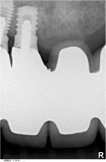 Figure 3. Postoperative radiograph of the resected dental implant in the right anterior maxilla