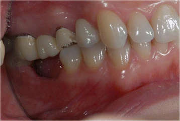 Figure 3. Some metal ceramic crowns in the upper left maxillary arch with a very poor esthetic appearance