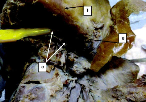 Figure 3. Submental artery as the source of the sublingual artery entering the MMLF: e submental artery, f inferior border of the mandible, and g facial artery
