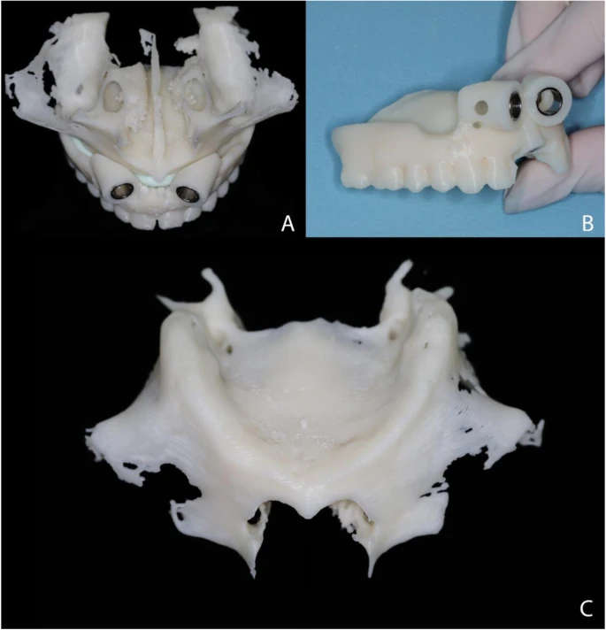 Figure 3. Surgical guide. a Surgical guide in occlusal view. b Surgical guide in frontal view. c Prototyped model of the atrophic maxilla