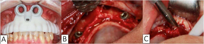 Figure 4. Insertion of the implant. a Prototyped surgical guide installed and stabilized. b Long transmaxillary implants are placed on both sides of the maxilla. c Long transmaxillary implant placement with the final insertion using a ratchet or tufted wrench