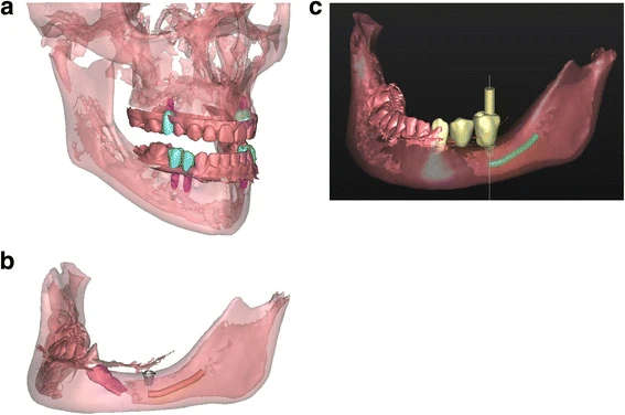 Figure 4. a Patient 1—virtual set-up of the ultimate treatment goal. b Patient 2—virtual set-up of the ultimate implant position. One short dental implant was planned in region 35, based on the location of the mandibular nerve (orange), the impacted 34 (pink) and the bone quality and volume. c Patient 2—virtual set-up of the ultimate prosthetic treatment goal