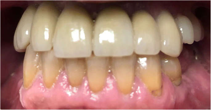 Figure 4. Post-operative frontal view with teeth in occlusion