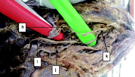 Figure 4. Sublingual artery originating from an anastomotic branch of the lingual and submental arteries: h submental artery, i hypoglossal artery, j lingual artery, and k anastomosis of the lingual and submental arteries