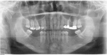 Figure 4. The panoramic radiography and cephalometric analysis revealed a partially edentulous mandible