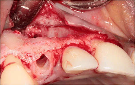 Figure 4. The prepared implant socket and osseous defect resulting from removal of the buccally impacted secondary canine and the primary canine. Note that the upper part of the alveolar crest is intact