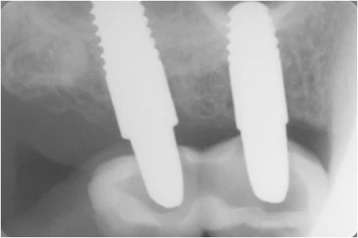Figure 5. Periapical X ray after 1 year of follow-up, the bone was stable and no sign of peri-implantitis was shown