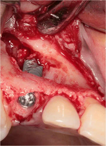 Figure 5. The implant is placed in the prepared socket