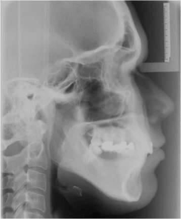 Figure 5. The panoramic radiography and cephalometric analysis revealed a partially edentulous mandible
