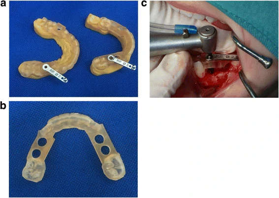 Figure 5. a Drilling templates of patient 1. Printed model of the maxilla (left) and mandible (right) with drilling template and metal drilling inserts (Nobel biocare). b Drilling template for the mandible of patient 1. c Implant placement of patient 1. Dental implant placement in the mandible using the virtual developed tooth-supported templates and metal drilling inserts