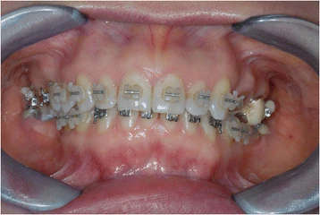 Figure 6. Orthodontic bracket placement: frontal view